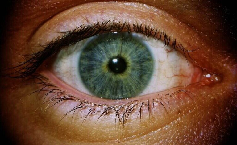 eye disorder